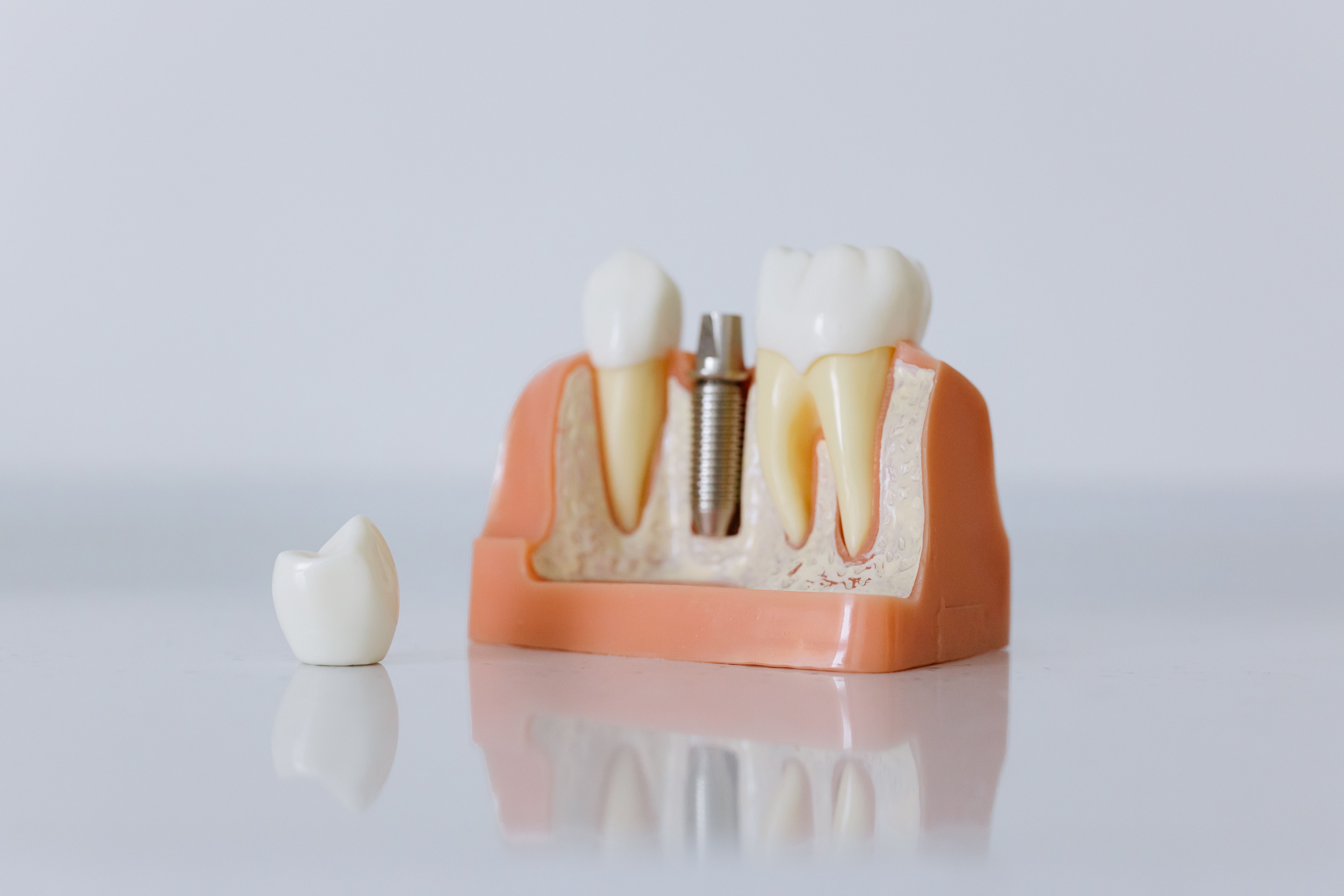 Model implantu zęba